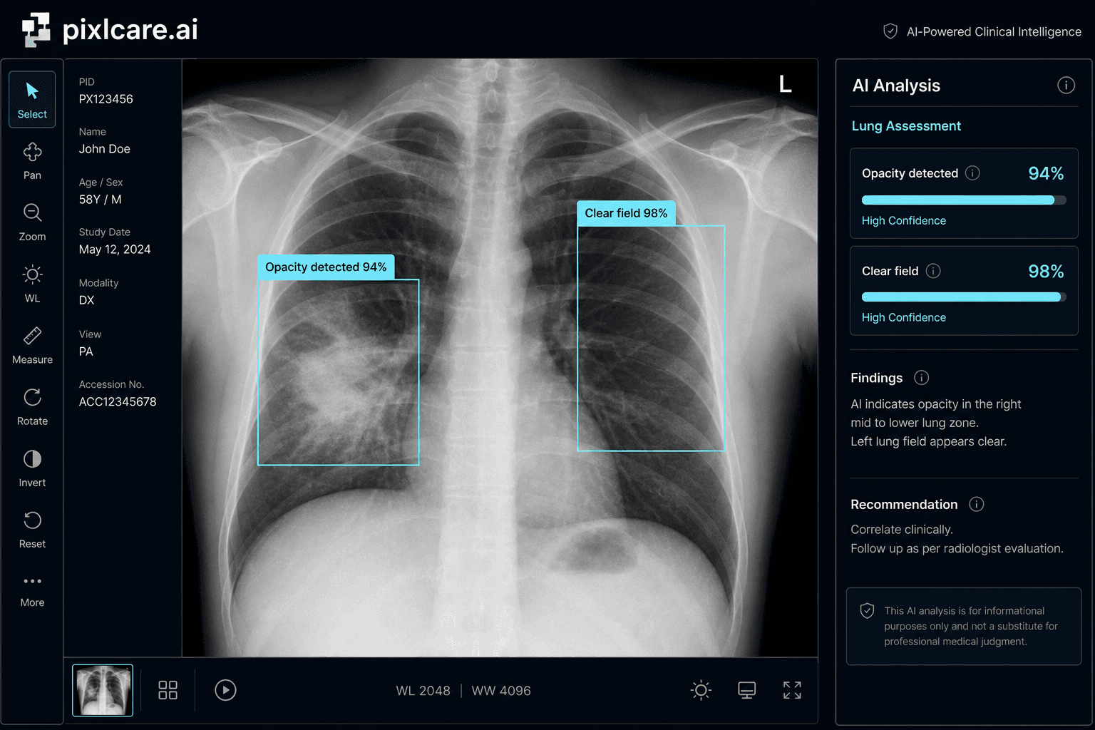 AI support for high-volume chest imaging